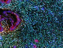 Tessuto del pancreas colpito dal tumore (fonte: Neelima Shah e Edna Cukierman, Fox Chase Cancer Center, National Cancer Institute, National Institutes of Health, da Flickr) (ANSA)