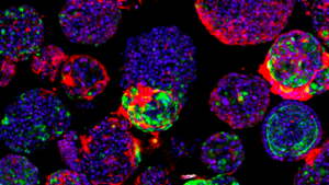 Organoidi del fegato coltivati in laboratorio aiutano a studiare i tumori del fegato. In verde le cellule staminali tumorali (fonte: Benedetta Artegiani / Princess Máxima Center for pediatric oncology) (ANSA)