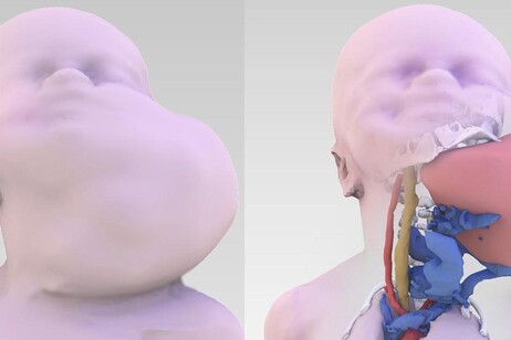 Ricostruzione 3D della massa tumorale del piccolo paziente nato con procedura EXIT-to-ECMO