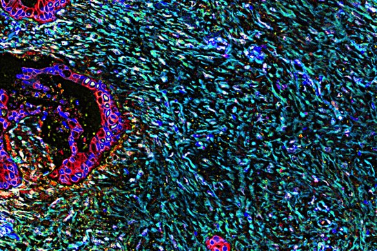 Tessuto del pancreas colpito dal tumore (fonte: Neelima Shah e Edna Cukierman, Fox Chase Cancer Center, National Cancer Institute, National Institutes of Health, da Flickr)
