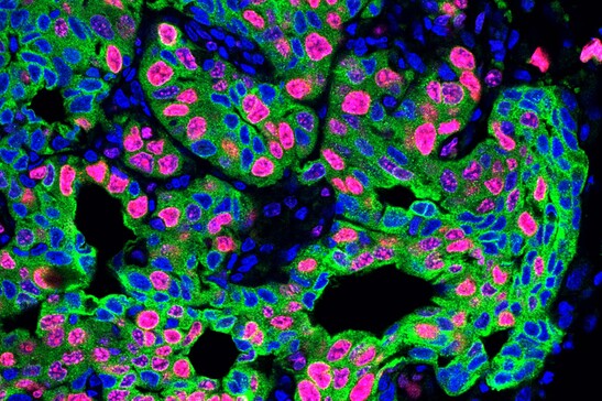 Le metastasi aumentano fino a quattro volte nei topi sottoposti a stress cronico (fonte: Egeblad lab/Cold Spring Harbor Laboratory)