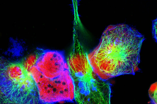 Cellule di neuroblastoma (fonte: vshivkova, da iStock)